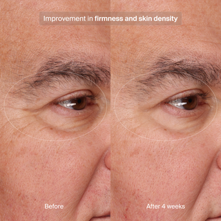 Precision Eye Lift