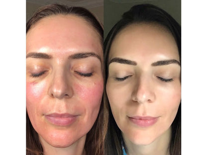 CO2Lift Pro Carboxy Gel Treatment - 3 Treatments