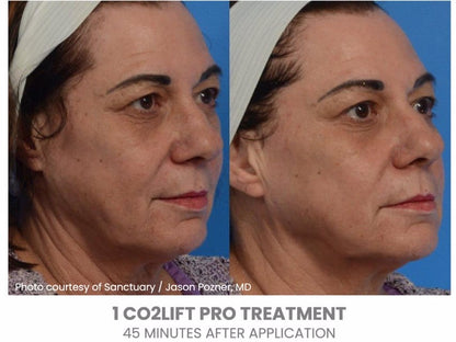 CO2Lift Pro Carboxy Gel Treatment - 3 Treatments